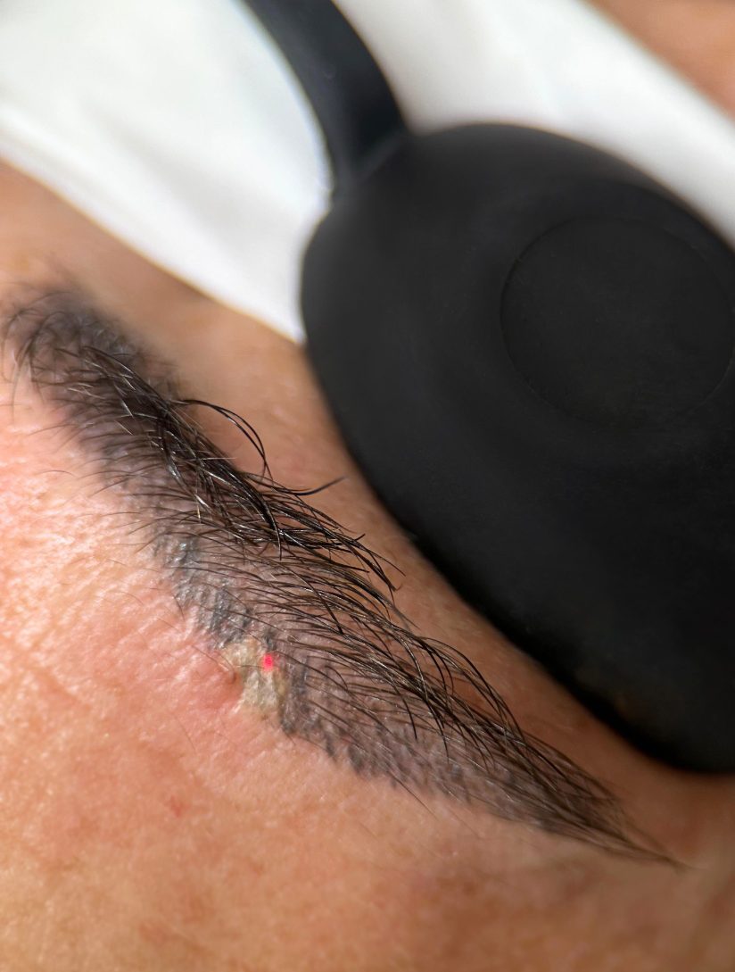 Ejemplo de tratamiento de eliminación de tatuaje con aparato de láser realizado por Sara Mas Maison de Beauté