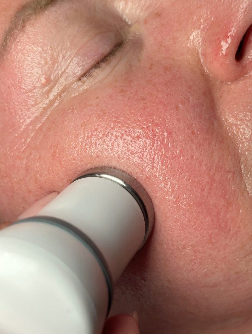 Ejemplo de tratamiento facial con aparatología realizado por Sara Mas Maison de Beauté